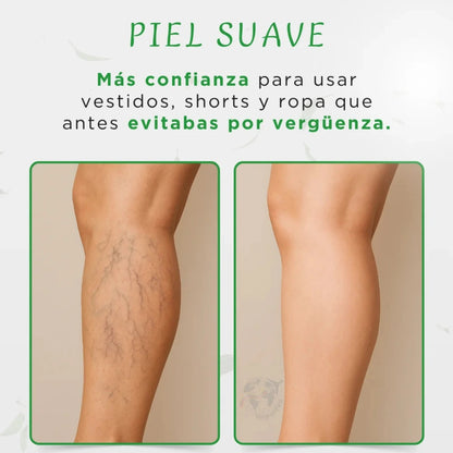 Crema elimina y previene varices a base de Té Verde🌿
